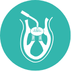 Transcatheter Mitral and Tricuspid Valve procedure (TMTV) icon